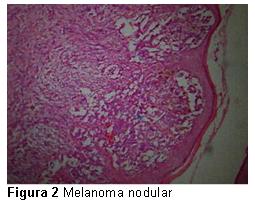 the Melonoma vulva and