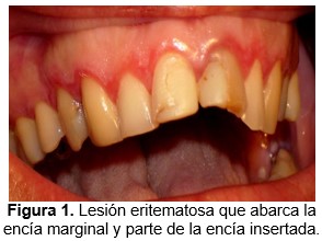 Gingivitis descamativa crónica: una manifestación gingival del liquen